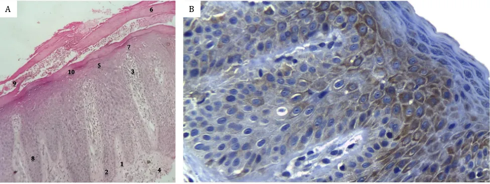 Figure 1. A) and B) PASI score calculation before and after treated with 1% sum of erythema severity (1–4), infiltration (1–4) and scales (1–4), multiply with the percentage of affected body surface area