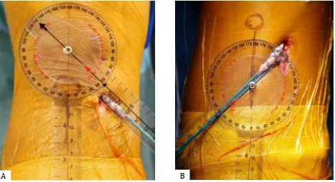 Figure 3. TTTG distance measurement. In the axial view of knee MRI, TTTG distance was measured from the midpoint of the trochlear groove, which was projected into a line connecting two femoral condyles (A), to the most anterior point of the tibial tubercle