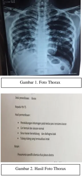 Gambar 2. Hasil Foto Thorax 