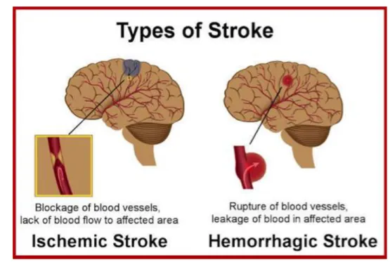 Gambar 2. 1 Tipe Stroke (sumber: Heart and Stroke Foundation of Canada,  2017) 