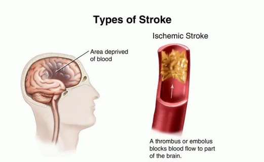 Gambar 2. 2 Stroke Iskemik (sumber: Relay Health, 2007) 