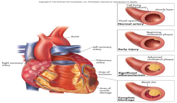 Gambar 2. 4 Proses Pembentukan Plak Aterosklerosis (sumber: Mc. Graw- Graw-Hill Companies, 2017) 