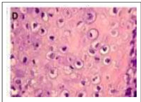 Gambar 11 : Osteosarcoma lakuna yang tidak normal dan   mengandung pleomorpik osteocyt 13 