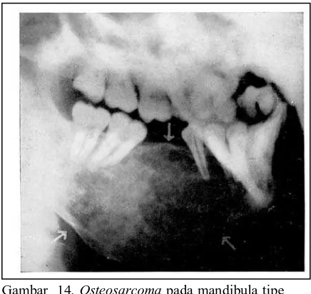 Gambar  14. Osteosarcoma pada mandibula tipe                                                         osteoblastik dimana terlihat daerah yang tebal berwarna putih menggantikan tulang cansellous dan     memperlihatkan gambaran radiolusen dan radiopak
