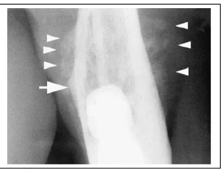 Gambar 17.Gambaran radiografi menunjukkan                                             adanya spicules (ujung panah) dan codman’s triangle (panah) pada osteosarcoma di mandibula.8 