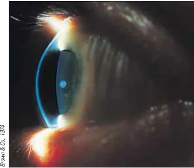 Figure 36.38 Close-up photograph of thecornea of the human eye.