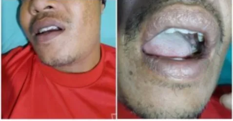 Gambar 2. Abses Submandibula  Pada  pemeriksaan  telinga,  hidung dan tenggorokan tidak ditemukan  kelainan.Pada  pemeriksaan  fasial  didapatkan  edema  regio  mandibula 