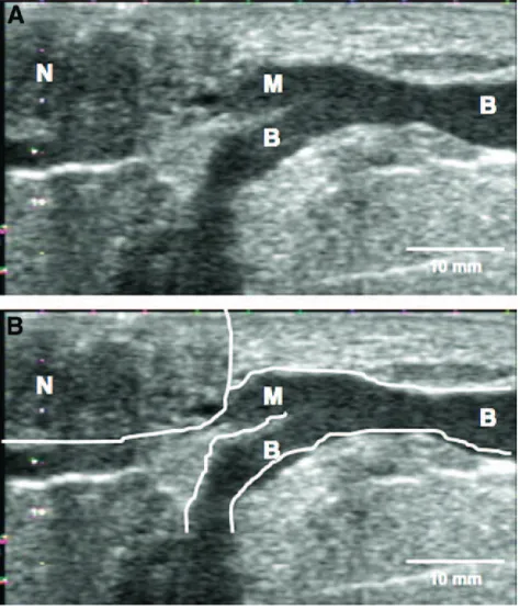 Figure 3. A and B, Ultrasound image of a main milk duct (Toshiba, Aplio).The nipple is the round hypoechoic (dark) structure in the left ofthe image (N)