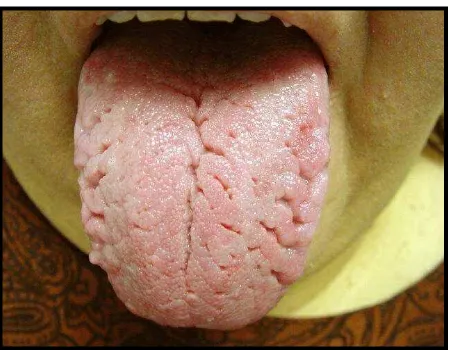 Gambar 5. Fissured tongue23 