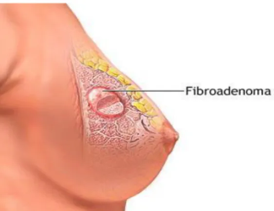 Gambar 2.Fibroadenoma mammae 