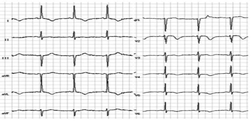 Gambar 3. EKG penderita dengan perdarahan subarachnoid akut, interval QT mengalami perpanjangan (QTc =613milidetik)