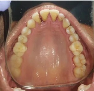 Gambar 4. Paska scalling dan kuretase. 
