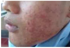 Gambar 1.3 Jerawat Tipe Sedang 