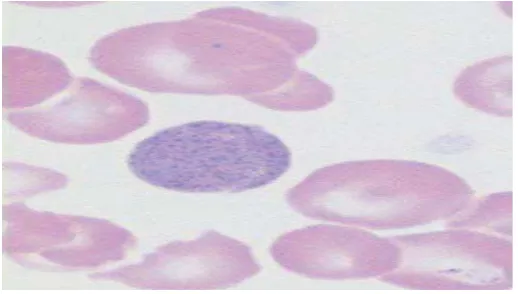 Gambar 2.1. Gambaran eritrosit basophilic stippling (Harald et al, 2004)  