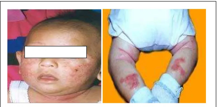 Gambar 2.2 Plak eritematosa difus dan kering pada pipi, fossa poplitea dan pada betis tampak plak eritematosa difus dan eksudatif   (Daili, 2005) 