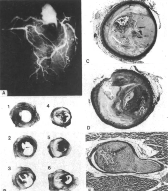 Gambar 1. Gambar A adalah hasil angiografi koroner invasif post mortem pasien meninggal 