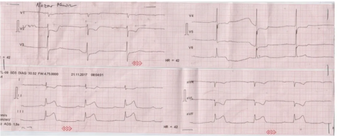 Gambar 1. Elektrokardiogram IGD RS BMC Padang 