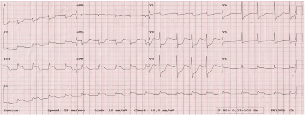 Gambar 2. Elektrokardiogram setting TPM 70/2/2 di CVCU RSUP Dr. M.  Djamil 