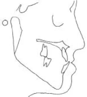 Figure 1 Characteristic deformities ofmandibular prognathism with a reversedoverjet
