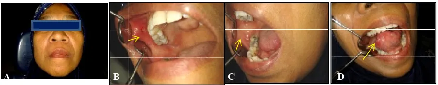 Figure 1 A Extra oral examination; right buccal mucosa; D white ulcer on the toxamination; B white ulcer in the upper right buccal mucosa; C white ulcer on the lowhite ulcer on the tongue.white ulcer on the lower 