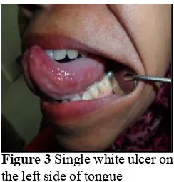 Figure 2 A Fold on the left buccal ulcers obtained white with reddish border, B Ulcer in the upper right mucosa buccal, C ulcer at tongue macular, D painless ulcer in the lower right mucosa buccal.