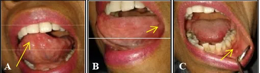 Figure 4 A At the tip of the tongue found white ulcers, B