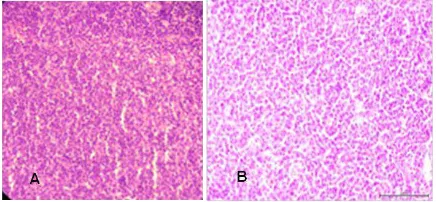 Gambar 2. A. Ekspresi CXCR4 pada limfoma folikuler derajat rendah, B. Limfoma folikuler derajat tinggi (pembesaran 400x)
