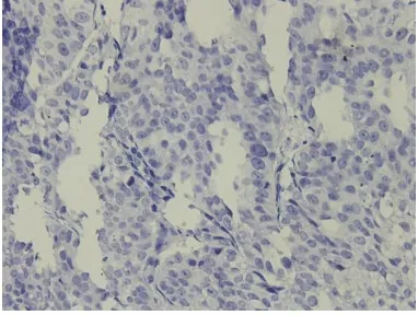 Gambar 1. Karsinoma urotelial infiltratif kandung kemih. A. Derajat rendah; B. Derajat tinggi