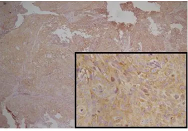 Gambar 1. Ekspresi HER-2/neu skor +1 pada karsinoma berdiferensiasi baik (insert pembesaran kuat)