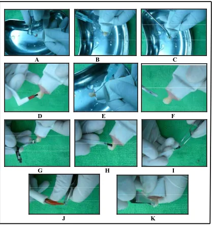 Gambar 3.9. Pemasangan   breket  Mini Edgewise  Nickel-Lite  Opti-MIM  dengan  menggunakan Advantage No-Mix Direct Bond Adhesive, A