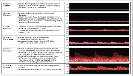 Gambar 3. Modifikasi TIBI flow grading system Dikutip dari: Eggers et.al.  2006. Handbook on Neurovascular Ultrasound
