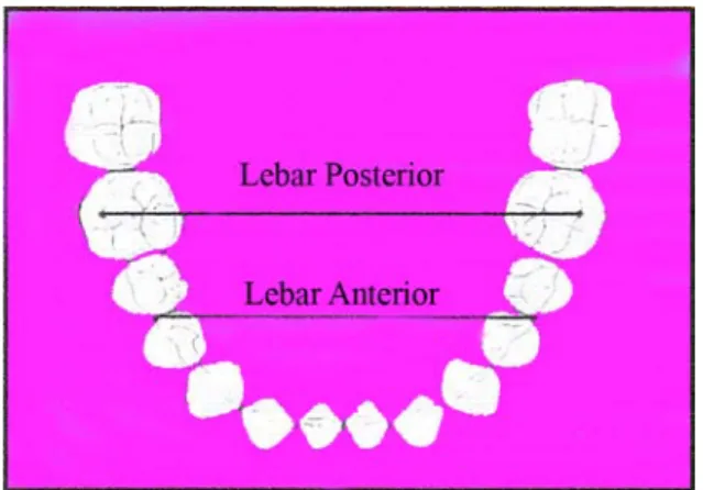 Gambar 3. Metode pengukuran lebar lengkung  gigi  rahang bawah menurut rakosi,  dkk  18