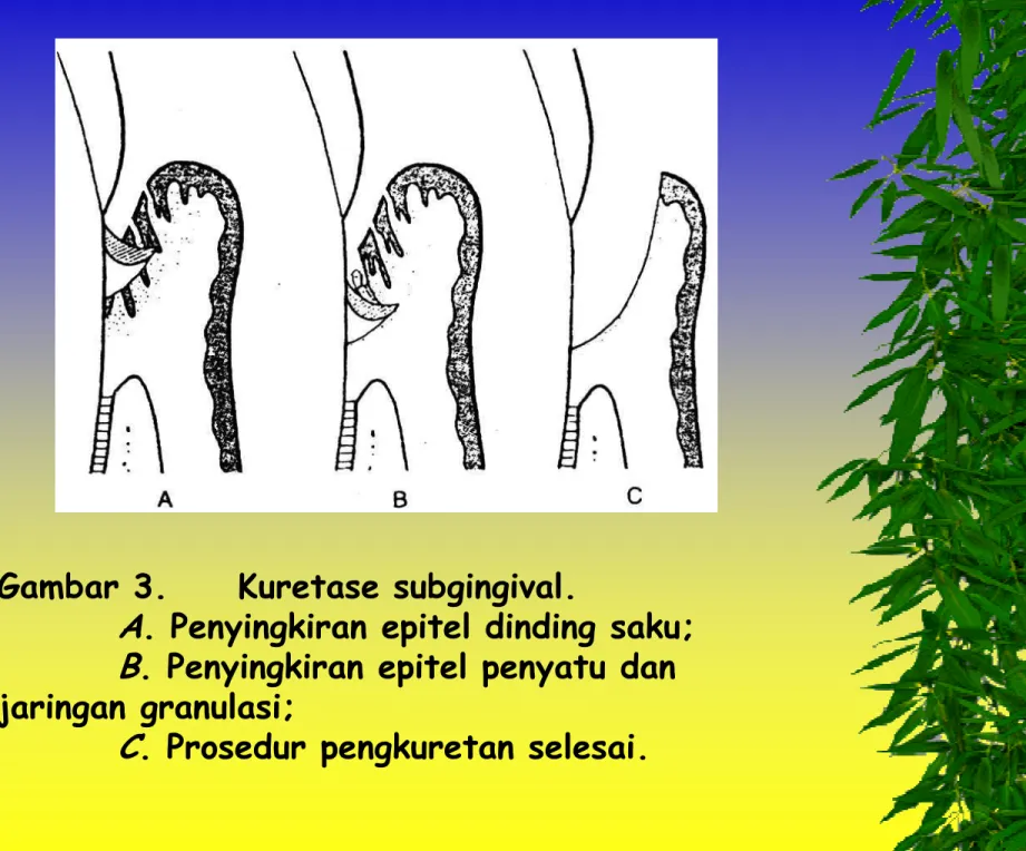 Gambar 3. Kuretase subgingival. 