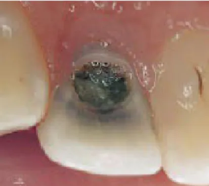 Gambar 2.2. Karies yang luas pada gigi (Beer et al., 2006 ; Schmerzaft &amp; Ekelig,   2009) 