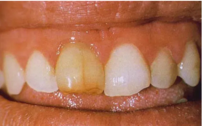 Gambar 2.6. Perubahan Warna Gigi setelah Perawatan Endodontik (Brenna et al.,   2009) 