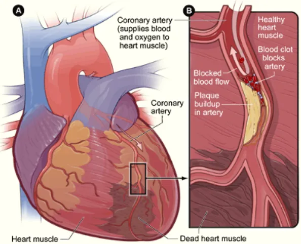 Gambar 2.3. Gambar A adalah gambaran dari arteri koroner jantung dan 