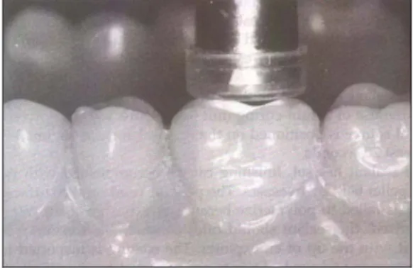 Gambar 2.7. Ujung dari LCU yang diposisikan ke permukaan oklusal   dari gigi molar yang dilapisi sealant