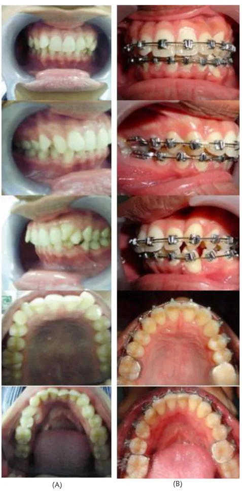 Gambar 7. Foto intraoral sebelum (A) dan setelah 1 tahun perawatan (B)