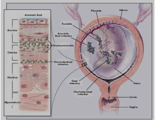 Gambar 2.1. Tempat-tempat potensial infeksi bakteri intra uteri(Goldenberg 2000)