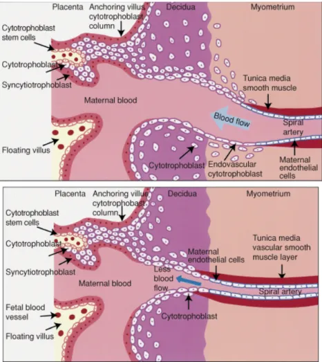 Gambar  2.1  Perbandingan  ilustrasi  proses  plasentasi  normal  (atas)  dan  plasentasi pada hipertensi gestasional (bawah) (Karumanchi et al., 2005) 