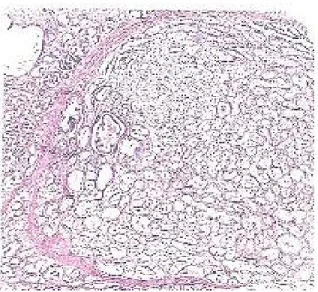 Gambar 2.6                                                                                                  Karsinoma adenum asinus prostat   Gleason pattern 1 (Eipstein et al., 2011) 