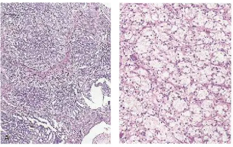 Gambar 2.9                                                                                                       Karsinoma adenum asinus prostat  Gleason pattern 4 (Eipstein et al., 2011) 