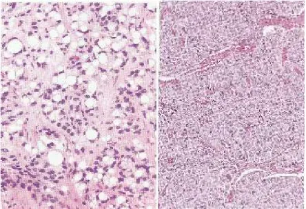 Gambar 2.10                                                                                             Karsinoma adenum asinus prostat  Gleason pattern 5 (Eipstein et al., 2011) 