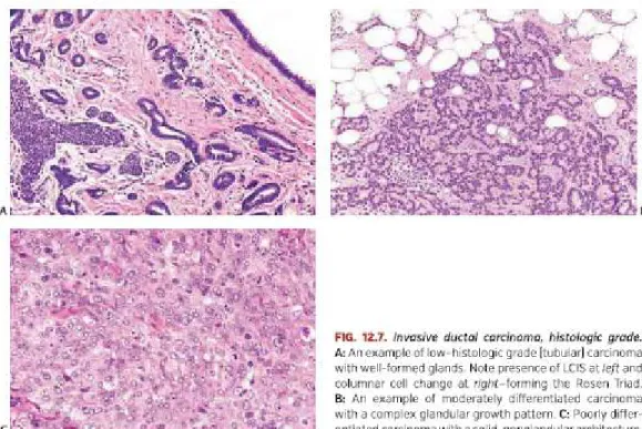 Gambar 2.1 Gambaran derajat histologis dari karsinoma payudara invasif. A. 