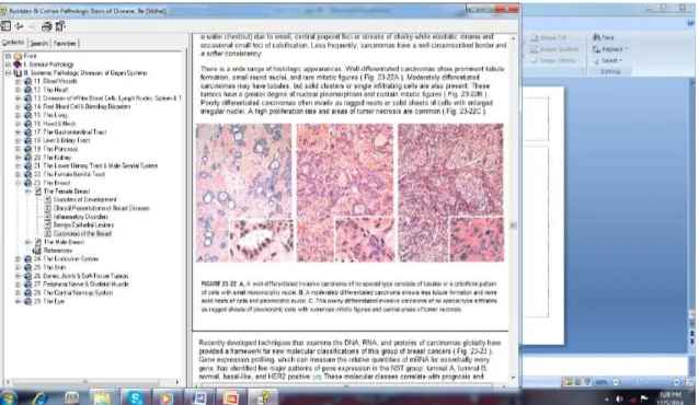Gambar 2.5 Gambaran karsinoma payudara invasif tipe tidak spesifik derajat  histologis I, II, dan III (Lester, 2010)