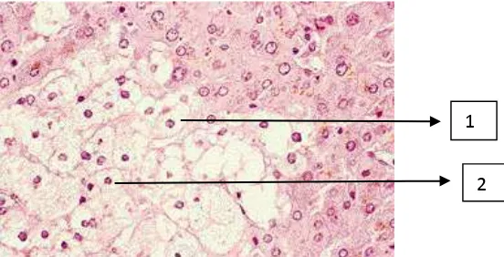 Gambar 2.4 Pembengkakan sel hati disertai vakuolisasi; Ket.: 1. Sel yang  Mengalami Vakuolisasi; 2