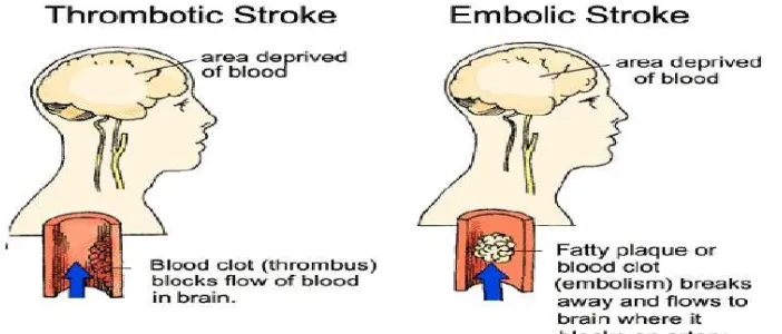 Gambar 2.1. Stroke trombotik dan stroke embolik (12) 