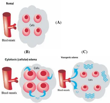 Gambar 2.1   Ilustrasi keadaan Sel Normal (A); Edema Sitotoksik (B), 