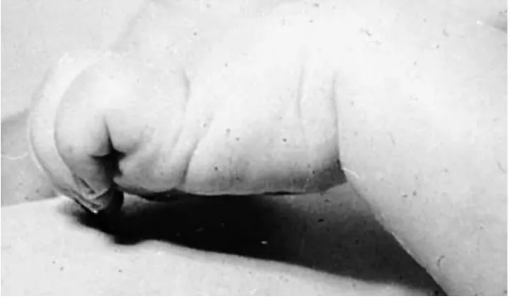 Gambar 20.Clawlike hand deformity pada Klumpke palsy.