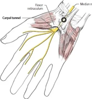 Gambar 22.Carpal tunnel syndrome.